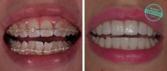 Ortodoncie - fotka před - Brandeis Clinic by Radoslav Lacina