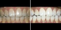Bělení zubů - fotka před - Brandeis Clinic by Radoslav Lacina
