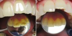 Dentální hygiena - fotka před - Brandeis Clinic by Radoslav Lacina