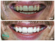 Bělení zubů - fotka před - Brandeis Clinic by Radoslav Lacina