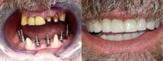 Zubní implantáty - fotka před - Dentální centrum - MUDr. Rafael Chajrušev