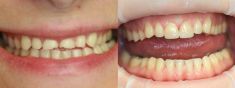 Zubní výplně (záchovná stomatologie) - fotka před - Dentální centrum - MUDr. Rafael Chajrušev
