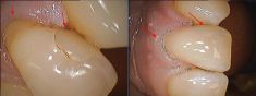 Zubní výplně (záchovná stomatologie) - fotka před - MDDr. Viktor Slíva