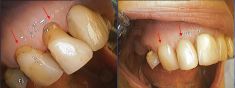 Zubní výplně (záchovná stomatologie) - fotka před - MDDr. Viktor Slíva
