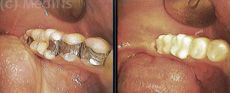 Zubní výplně (záchovná stomatologie) - fotka před - Medifis clinic