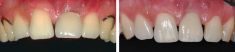 Zubní implantáty - fotka před - Dentální centrum Podkovka, s.r.o.