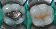 Zubní výplně (záchovná stomatologie) - fotka před - Dentální centrum Podkovka, s.r.o.