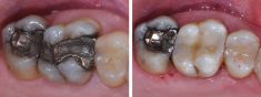 Zubní výplně (záchovná stomatologie) - fotka před - Dentální centrum Podkovka, s.r.o.