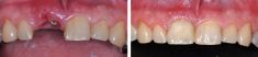 Zubní implantáty - fotka před - MUDr. Jan Špiller