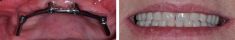 Zubní implantáty - fotka před - MUDr. Jan Duba