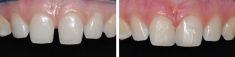 Zubní výplně (záchovná stomatologie) - fotka před - MUDr. Jan Duba