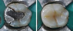 Zubní výplně (záchovná stomatologie) - fotka před - MUDr. Jan Duba