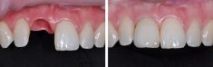 Zubní implantáty - fotka před - MUDr. Daniel Šourek