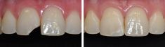 Zubní výplně (záchovná stomatologie) - fotka před - MUDr. Daniel Šourek