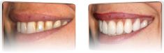 Bělení zubů - fotka před - DENTICS DR. BARAN, s.r.o. - Studio pokročilé stomatologie