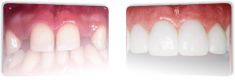 Zubní implantáty - fotka před - DENTICS DR. BARAN, s.r.o. - Studio pokročilé stomatologie