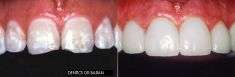 Keramické fazety - fotka před - DENTICS DR. BARAN, s.r.o. - Studio pokročilé stomatologie