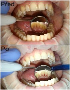 Dentální hygiena - Dentální hygiena