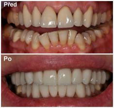 MDDr. Ondřej Klika - 20 fazet a korunek, materiál: lithium disilikát