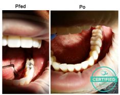 Zubní výplně (záchovná stomatologie) - fotka před - MDDr. Ondřej Klika