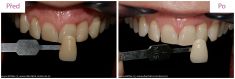 Bělení zubů - fotka před - MUDr. Martin Kittler