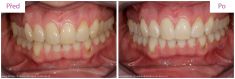 Bělení zubů - fotka před - MUDr. Martin Kittler