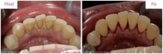 Dentální hygiena - fotka před - MUDr. Martin Kittler