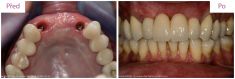 Zubní implantáty - fotka před - MUDr. Martin Kittler