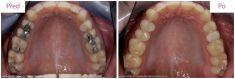 Zubní výplně (záchovná stomatologie) - fotka před - MUDr. Martin Kittler