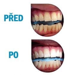 Dentální hygiena - fotka před - Krásné zoubky