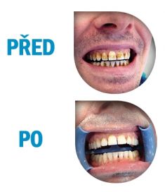 Dentální hygiena - fotka před - Krásné zoubky