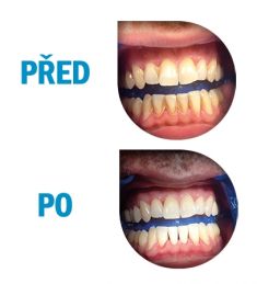 Dentální hygiena - fotka před - Krásné zoubky