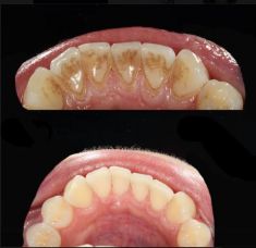 Dentální hygiena - fotka před - THE CLINIC