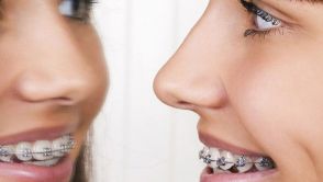Rovné zuby v každém věku – rovnátka dávno nejsou jen pro teenagery