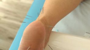 Léčba suchou jehlou - Dry Needling