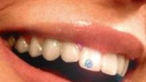Cesta k zářivému úsměvu: dentální šperky