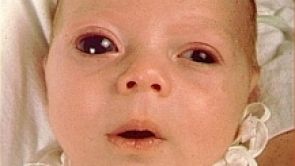 Vrozený glaukom (dětský zelený zákal)