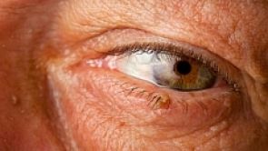 Odstranění xantelazmat (tukových usazenin v okolí očí)