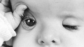 Ptóza očního víčka u dětí