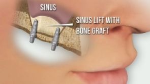 Sinus lift - augmentace čelistní kosti