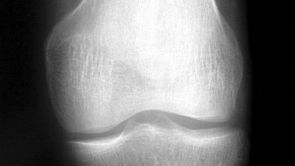 Použití kmenových (SVF) buněk při artróze (osteoartróze)