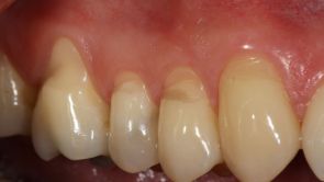 Ošetření citlivých zubů