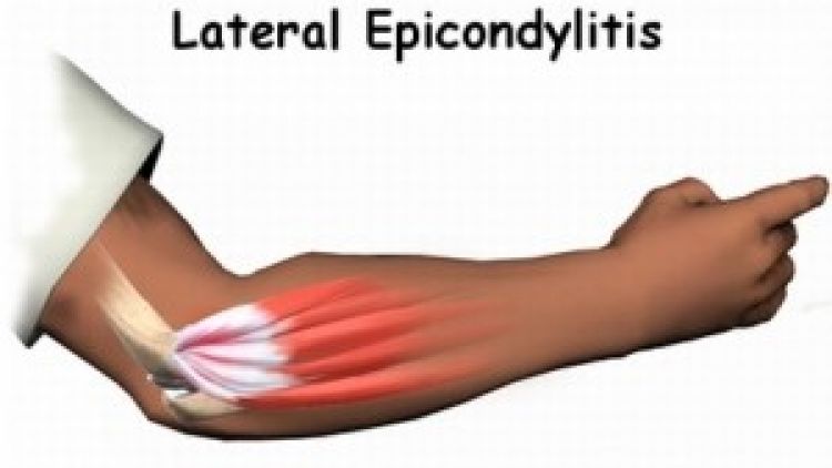 Trápí vás tenisový loket?