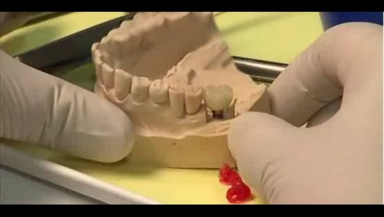 Dentální implantát místo chybějícího zubu