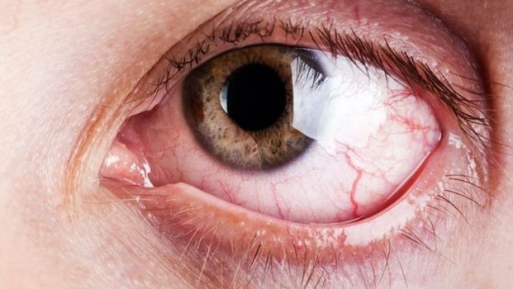 Plugy - Nová metoda pro léčbu syndromu suchého oka
